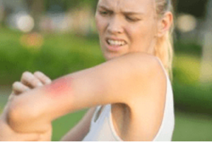 girl scratching a spider bite on her arm